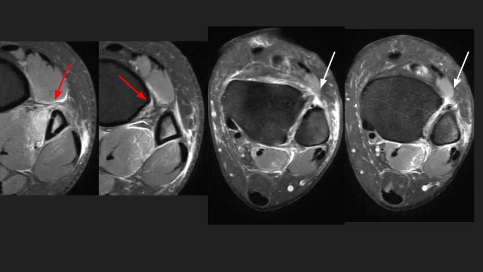 Figure 1 for case syndesmosis ( RID6088 )